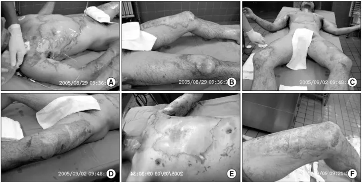 Fig. 5.  Clinical  cases  (2nd  degree  burn  wound),  electric  flash  burn  18%  TBSA,  M/36