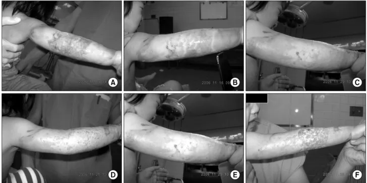 Fig. 7.  Clinical  cases  (3rd  degree  burn  wound),  Scalding  burn  6%  TBSA,  F/1