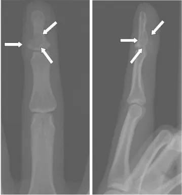Fig. 2. A. High-resolution US demonstrates lobulated soft tissue mass (arrows) with internal punctate hyper-echoic foci (calcifications).