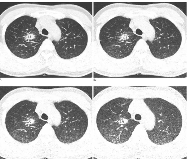 Fig. 1. Transverse CT scans were acquired at tube currents of 32 (A), 16 (B), 8 (C), and 4 (D) mAs