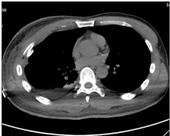 Fig. 2.  Chest  X-ray  of  Patient  Case  2.  The  yellow  circle  indicates  Rt.  multiple  rib  fracture  and  chest  wall  deformity.
