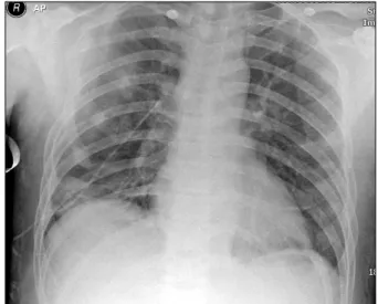 Fig. 4.  Chest  AP  X-ray  of  Patient  Case  2.  There  is  Rt.  CPA  blunting. 