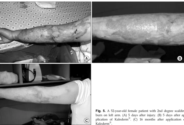 Fig. 5.  A  52-year-old  female  patient  with  2nd  degree  scalding  burn  on  left  arm