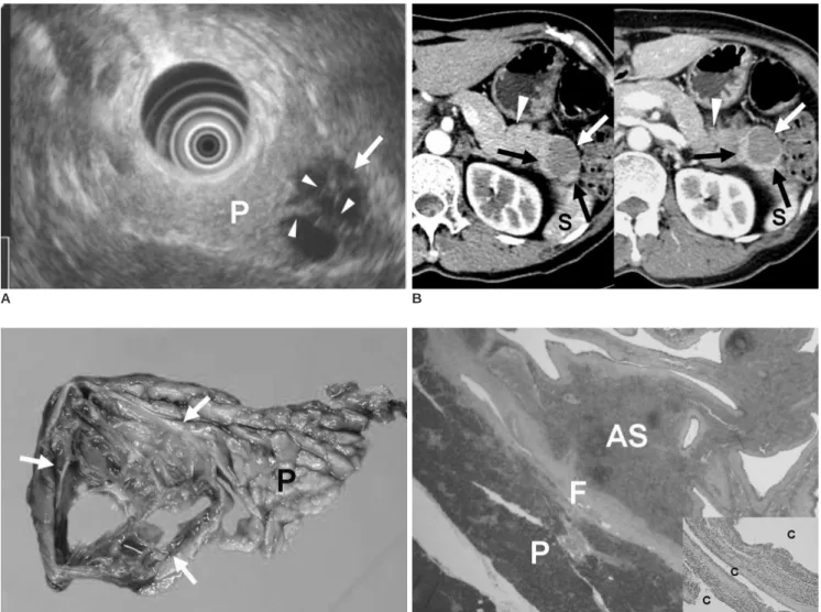 Fig. 11. Epidermoid cyst in intrapancreatic accessory spleen. 