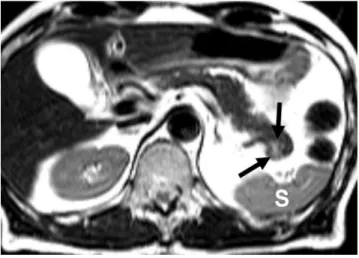 Fig. 1. Gross pathologic and histologic findings of intrapancreatic accessory spleen. 