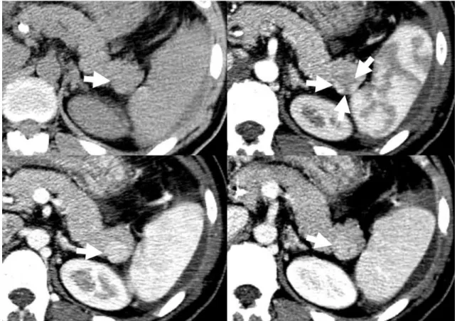 Fig. 5. Typical multidetector CT appearance of intrapancreatic accessory spleen. On precontrast CT image (left upper), lesion shows iso- iso-attenuation compared to pancreas and spleen