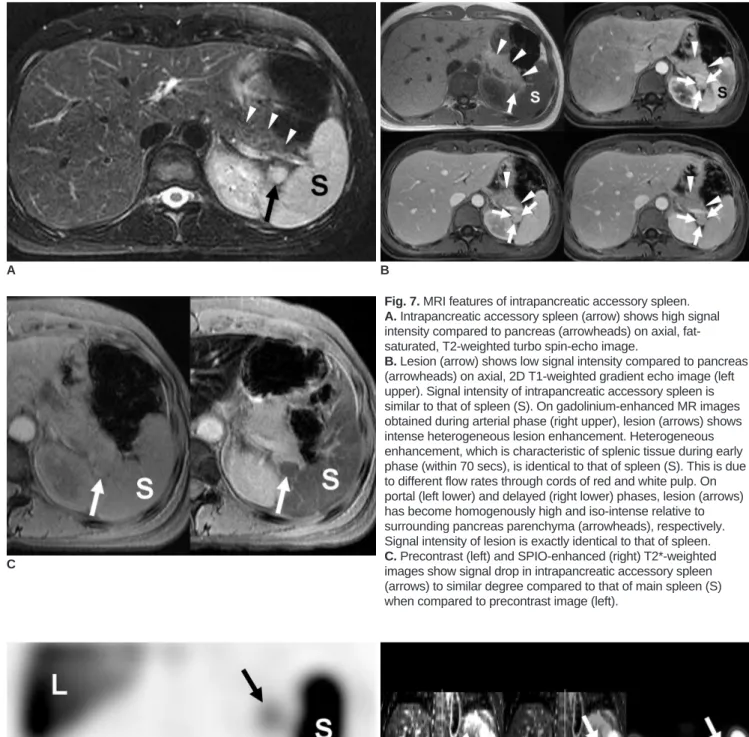 Fig. 7. MRI features of intrapancreatic accessory spleen. 