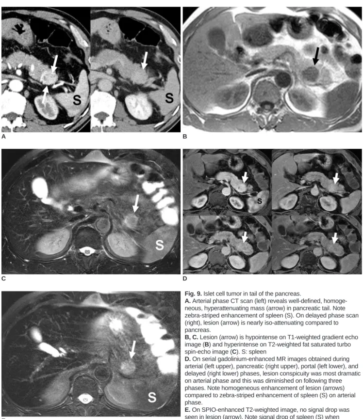 Fig. 9. Islet cell tumor in tail of the pancreas. 