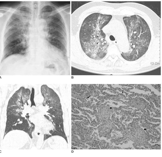 Fig. 1. Lansoprazole-induced interstitial lung disease. 