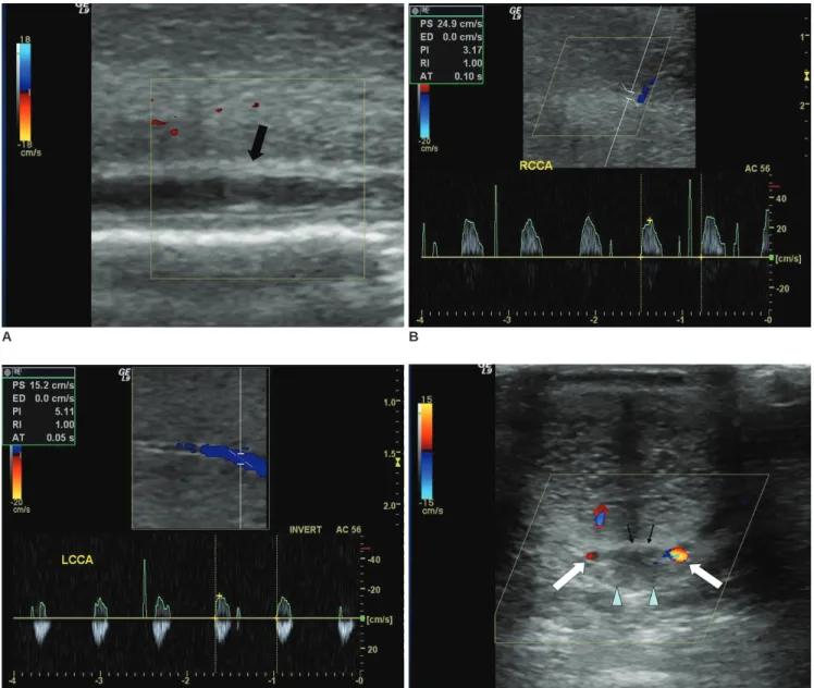 Fig. 1. Penile Mondor’s disease in 38-year-old man.