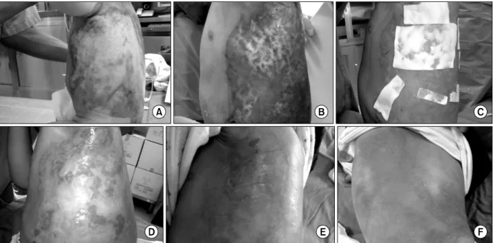 Fig. 1.  Treatment  of  deep  second  degree  burn  wound  using  heterogenic  type  I  collagen  dressing