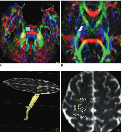 Fig. 1. Region of interest selection for diffusion tensor tractography at pons, posterior limb of internal capsule and precentral gyrus