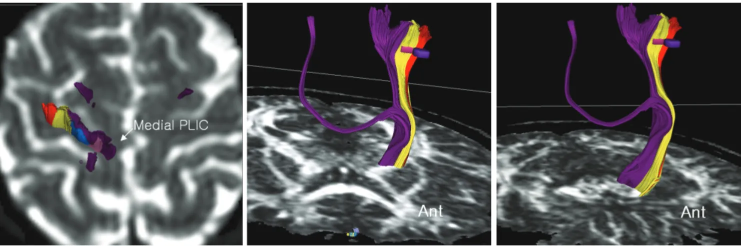 Fig. 2. Fiber tracts from medial half of posterior limb of internal capsule by single region of interest tracking