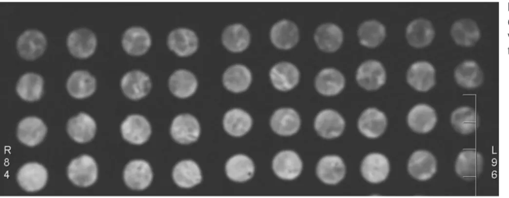 Fig. 2. CT image of 40 ground-glass opacity nodules. Mean attenuation values of nodules range from  754 HU to  352 HU.