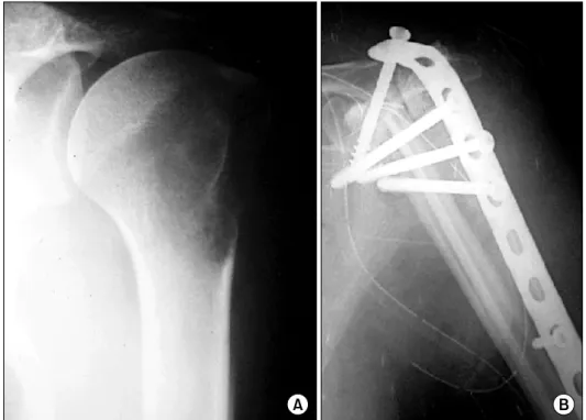 Fig. 1.  (A)  The  Röentgenogram  shows  osteolytic  lesion  on  the  left  proximal  humerus  due  to  stage  IIB  osteosarcoma