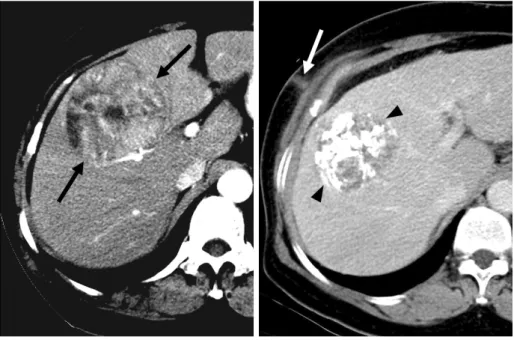 Fig. 1. 65-year-old woman with linear or elongated configuration of needle tract implantation after percutaneous biopsy of subcapsular hepatocellular