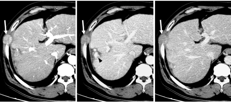 Fig. 4. 63-year-old man with needle tract implantation after percutaneous biopsy using tru-cut needle.