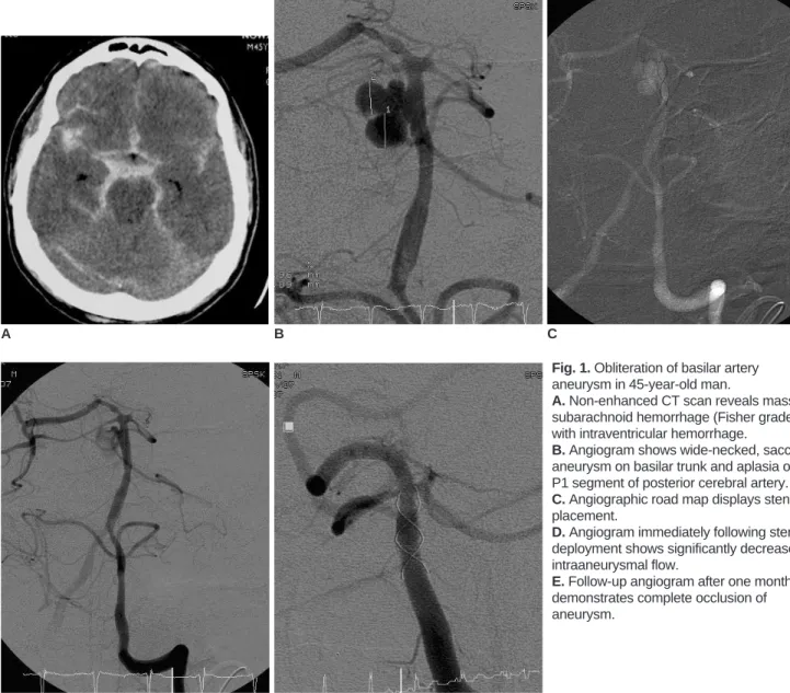 Fig. 1. Obliteration of basilar artery aneurysm in 45-year-old man.