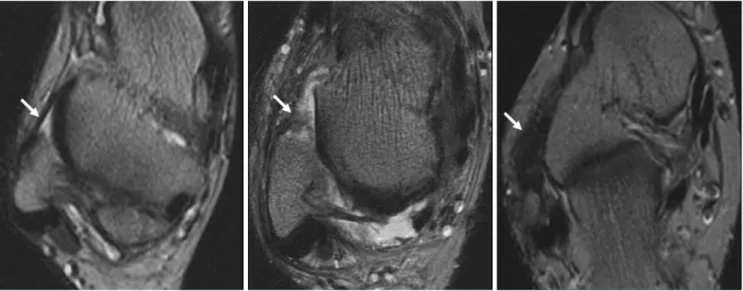 Fig. 1. Imaging findings of normal anterolateral recess of ankle and soft tissue impingement at anterolateral recess of ankle as depicted by use of routine MR