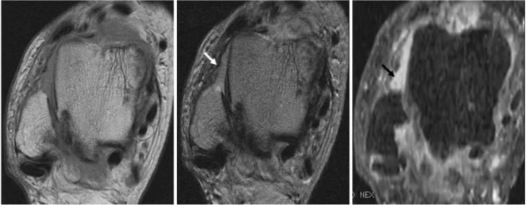 Fig. 3. 56-year old woman with chronic ankle pain. This was true positive case diagnosed by both routine MRI and contrast enhanced fat-suppressed 3D-FSPGR MRI