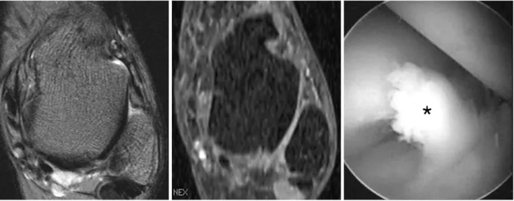 Fig. 5. 33-year-old man with chronic ankle pain. This was contrast enhanced 3D-FSPGR MRI false negative case but routine MRI true positive case