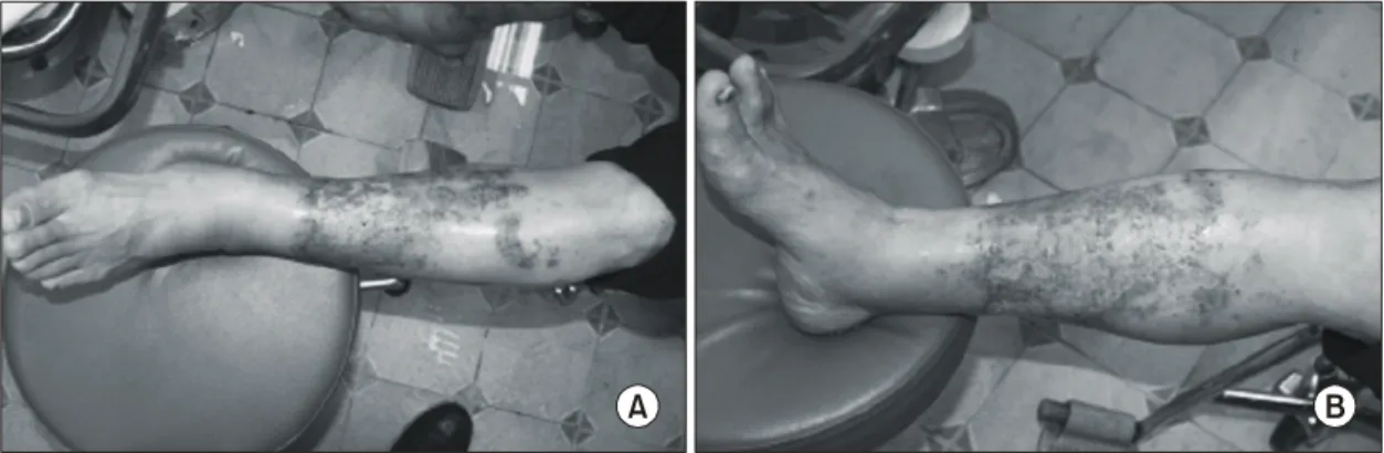 Fig. 1.  A  41  years  old  male  patient  who  had  deep  dermal  injuries.  The  thick  eschar  with  denuded  epidermis  and  partial  bullaes  were  noticed