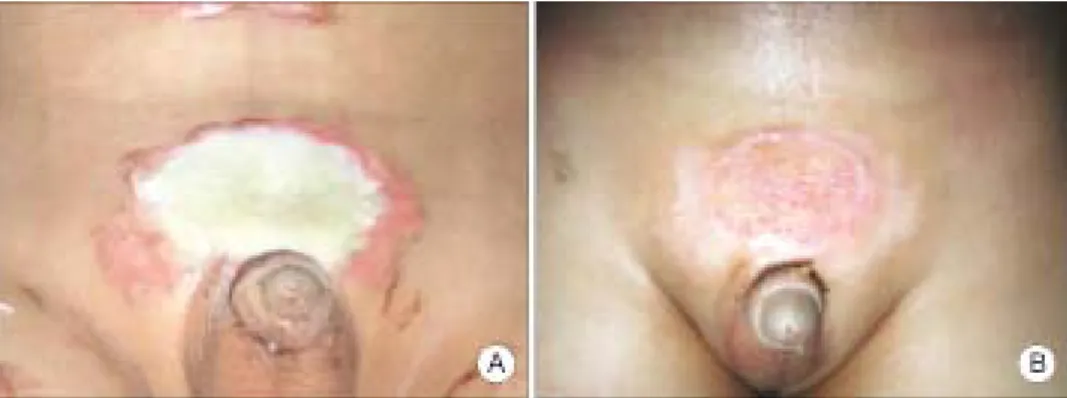 Fig.  2.  Mid  second-degree  burn.  A:  Note  the  pink-white  appearance  after  removal  of  the  blister