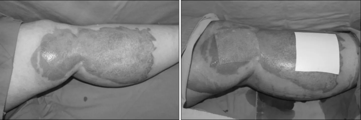 Fig. 3.  A  37-year-old  woman  had  Deep  2 nd   and  partial  3 rd   degree  scalding  burn