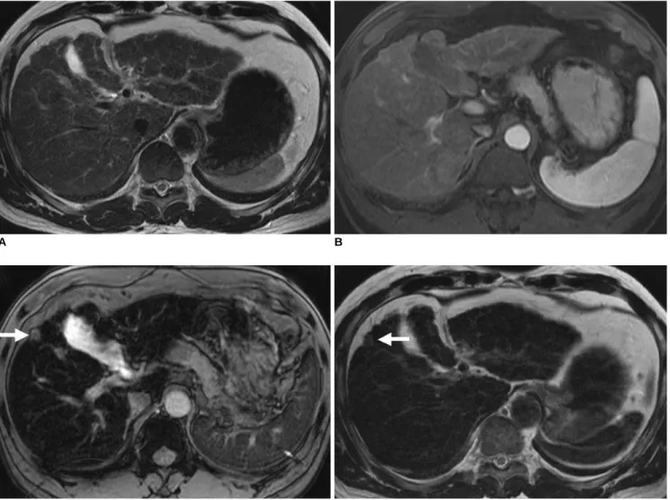 Fig. 1. 55-year-old man with well-differentiated hepatocellular carcinoma in subcapsular area of right hepatic lobe.