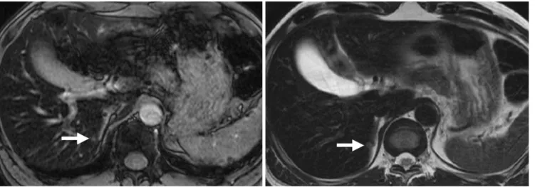 Fig. 3. 57-year-old man with surgically confirmed 0.4-cm liver metastasis from rectal cancer.