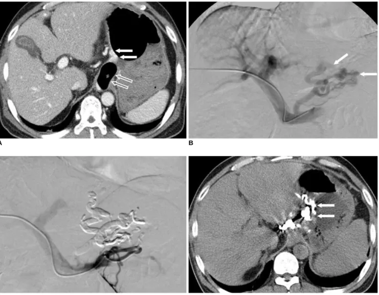 Fig. 1. 50-year-old man with gastric varices.