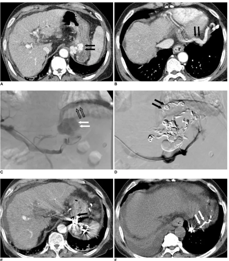 Fig. 2. 69-year-old man with severe gastric varices draining into large pericardiophrenic vein.