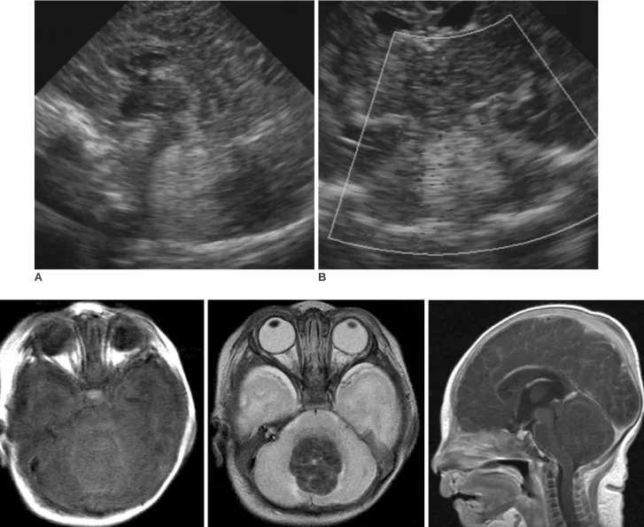Fig. 1. Mixed germ cell tumor presenting with hemorrhage in newborn.