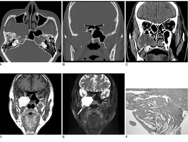 Fig. 1. 78-year-old male patient with right infratemporal fossa mass arising from right sphenoid sinus.