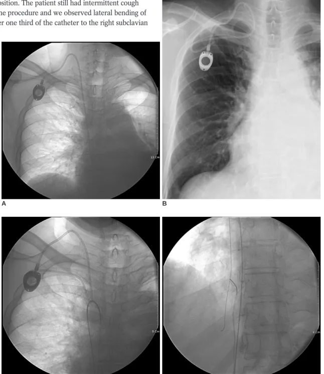 Fig. 1. Migration of implantable port catheter in 64-year-old man.