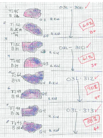 Fig. 1. The amount of residual tumor remaining in the kidney at post treatment was assessed from H &amp; E stained sections of paraffin-embedded, formalin-fixed tissues (see text)
