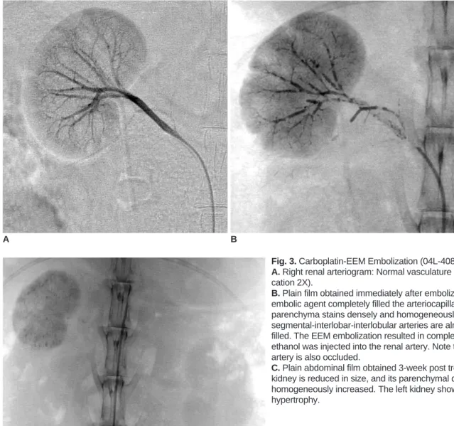 Fig. 3. Carboplatin-EEM Embolization (04L-408). 