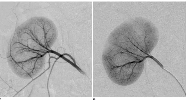 Fig. 4. EEM embolization (03L-326). 