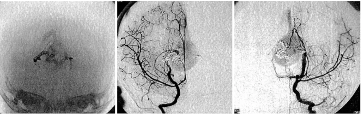 Fig. 2. Angiography shows a vein of Galen aneurysmal malformation that is supplied from the bilateral posterior cerebral arteries and their branches (A