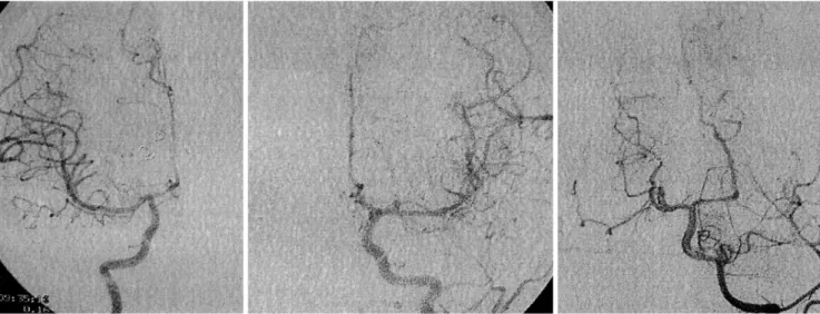 Fig. 4. Follow-up angiography three months after the procedure shows that the VGAM totally disappeared