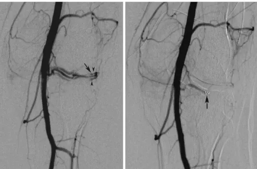 Fig. 1. A. Digital subtraction intraarterial angiography reveals a pseudoaneurysm originating from the inferior genicular artery (arrow) with shunting of contrast into the venous system (arrowheads).