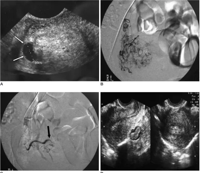 Fig. 1. Selective uterine artery embolization in a 27-year-old woman with interstitial ectopic pregnancy.