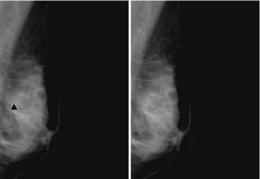 Fig. 2. A 56-year-old woman with malignant microcalcifications in the left breast. 