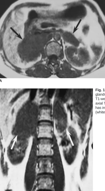Fig. 1. Abdominal MRI demonstrates that the masses in the bilateral adrenal glands are homogeneous hypointense to the liver (black arrow) on the axial T1-weighted spin echo image (A) and hyperintense (white arrow) on the axial T2-weight spin echo image (B)