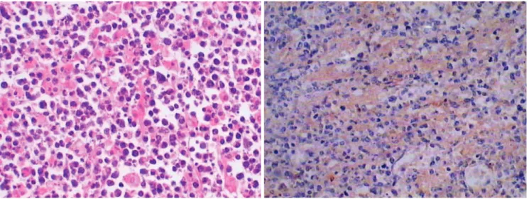Fig. 2. A. Photomicrography of the histology specimen shows the tumor consists of poorly-differentiated plasma cells with large and hyperchromatic nuclei (Haematoxylin &amp; Eosin,  300)