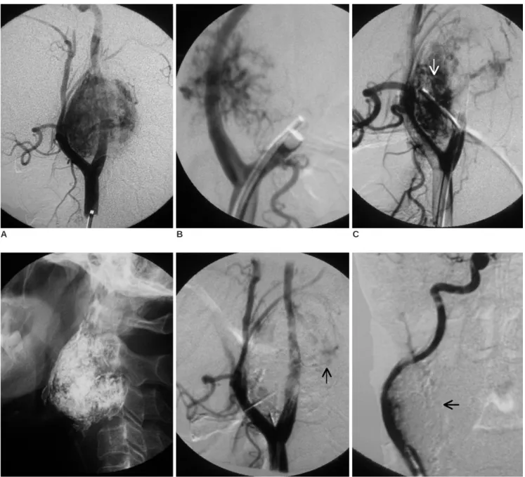 Fig. 1. A. Right carotid injection in the lateral view shows the hypervascular tumor with posterior displacement of the internal carotid artery