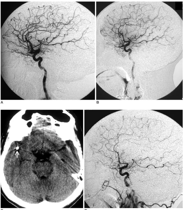 Fig. 2. A. Preprocedure right carotid injection in the lateral view shows the normal intracranial circulation