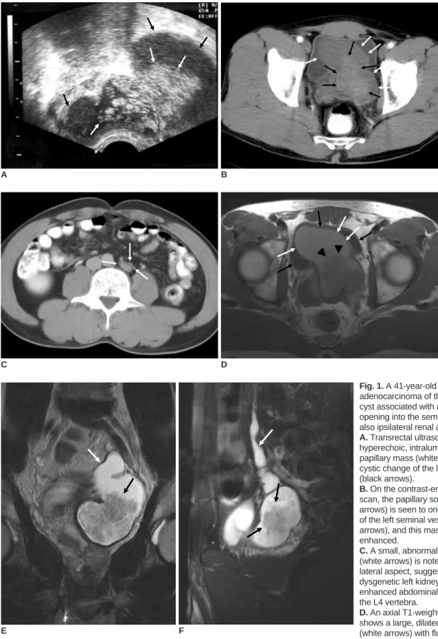 Fig. 1. A 41-year-old man with adenocarcinoma of the seminal vesicle cyst associated with an ectopic ureter opening into the seminal vesicle and also ipsilateral renal agenesis.