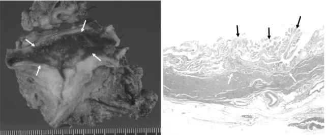 Fig. 1. G. The gross specimen shows the internal surface of the seminal vesicle cyst with a residual papillary mass (arrows)