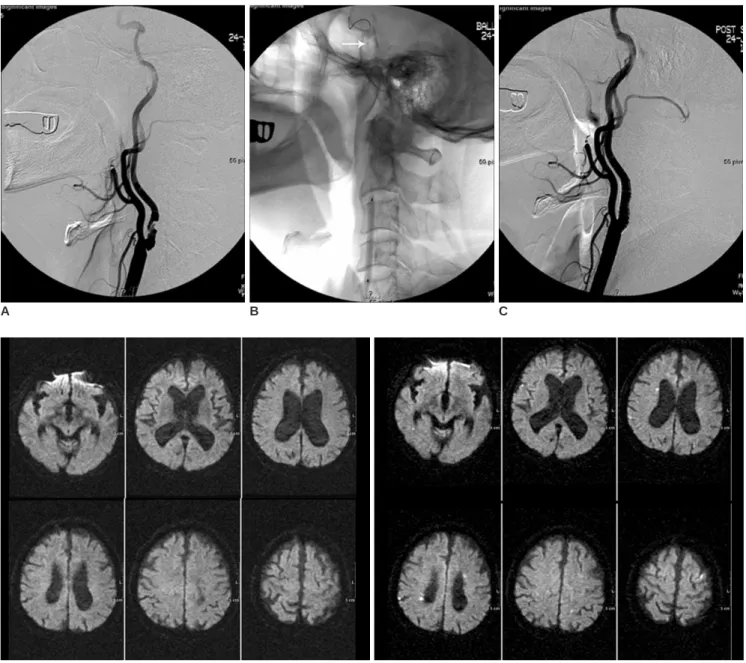 Fig. 1. A 72-year-old man who underwent protected carotid artery stenting with a balloon device.